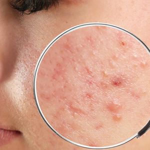 Your-Ultimate-Acne-Guide-featured