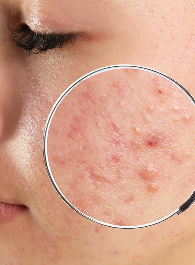 Your-Ultimate-Acne-Guide-featured