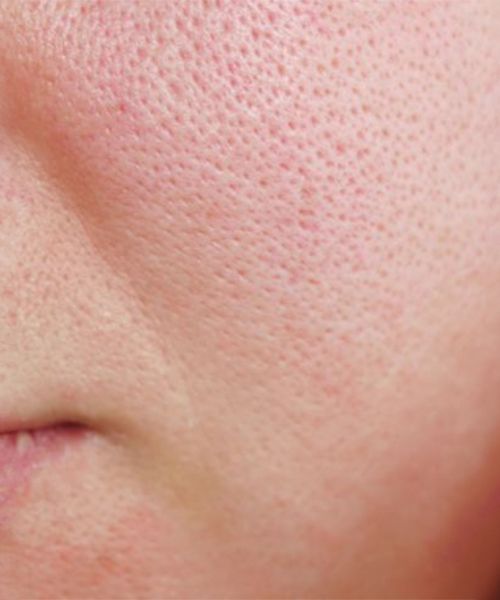 Enlarged Pores